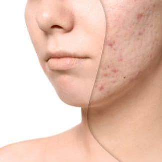 Acne & scar treatment