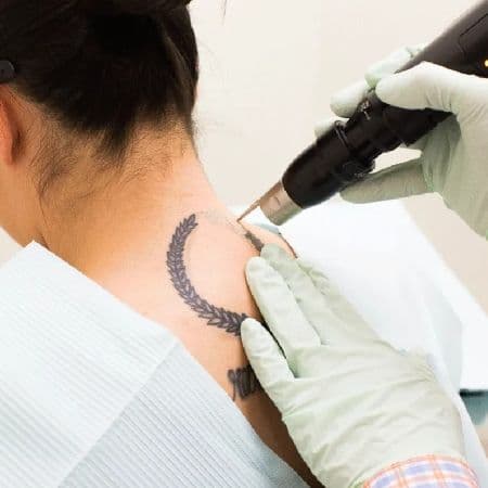 Tattoo removal